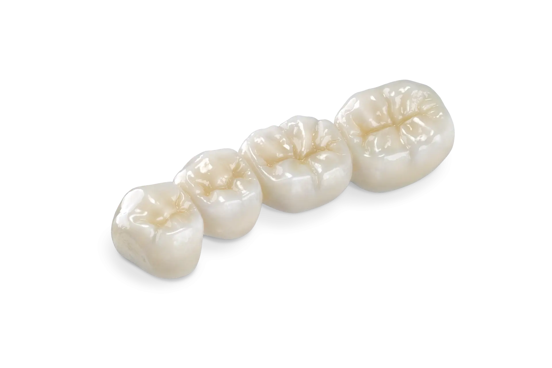 BruxZir FS 4-unit dental bridge used for durable and aesthetic tooth restoration