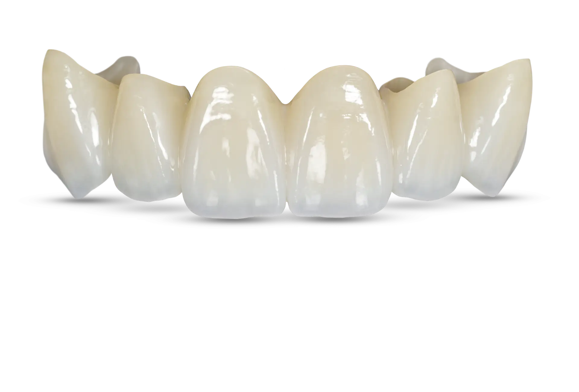 BruxZir 6-unit dental bridge used for durable and aesthetic tooth restoration