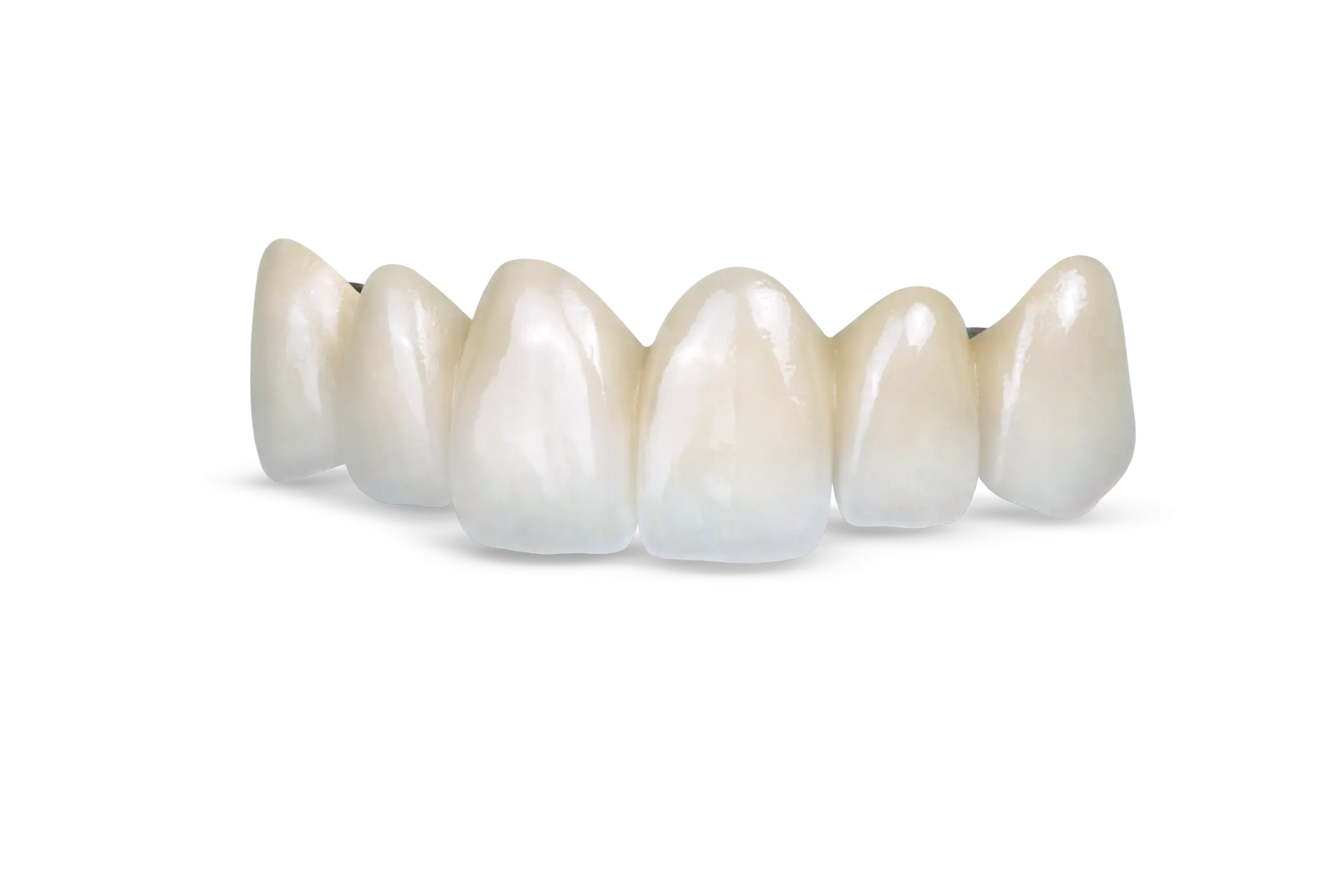 Obsidian pressed-to-metal dental bridge used for durable and aesthetic tooth restoration